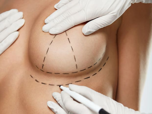 HR Plastic Surgery - GalaFLEX Mesh Internal Bra in Modern Mastopexy